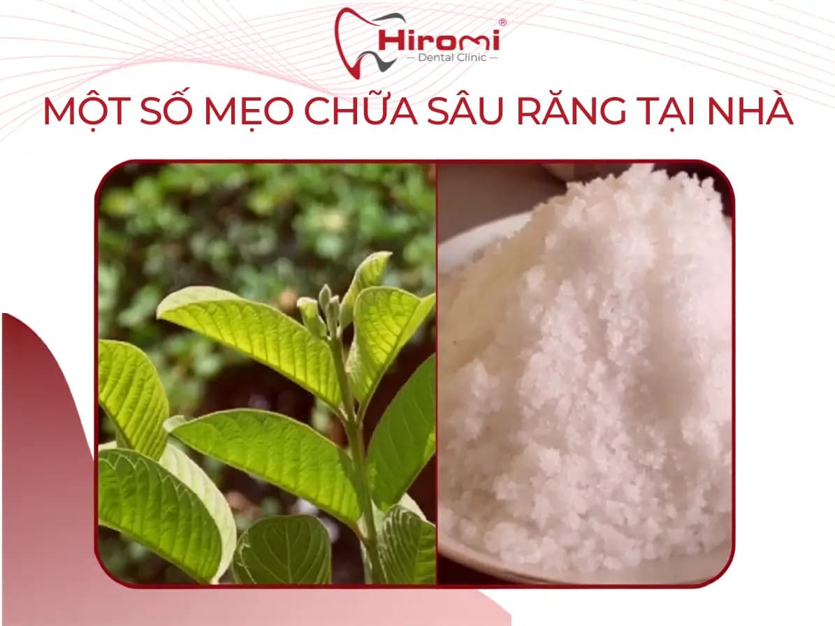 7 Cách Chữa Sâu Răng Tại Nhà Hiệu Quả