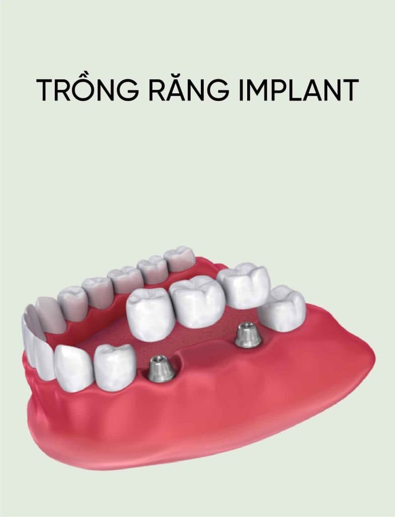 Trồng Răng Implant